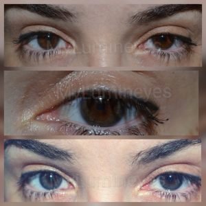 laser-eye-color-change-how