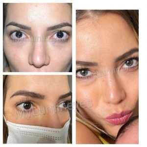 world-best-laser-eye-color-change-barcelona-mexico-istanbul