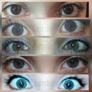 dark-brown-blue-eyes-laser-color-change-before-after