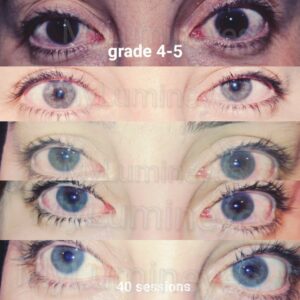 grade5-to-blue-eyes-laser-color-change