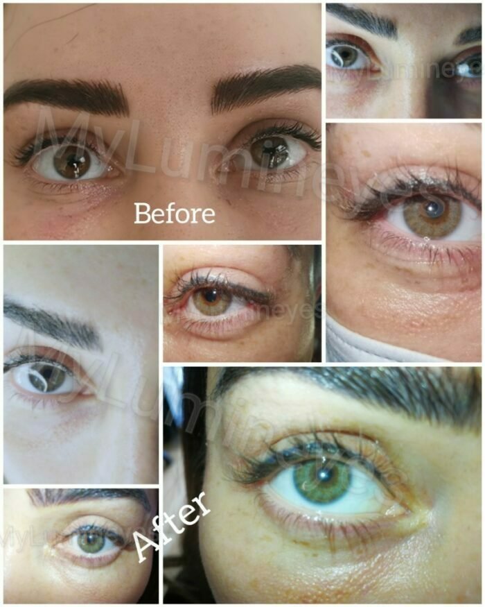 Eye Color Change Surgery Costs with Lasers Permanent