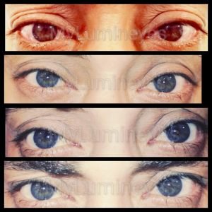 before-after-laser-eye-color-change-photos-videos-lumineyes-real