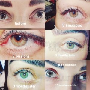 best-laser-eye-color-change-brown-blue-green-before-after
