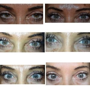 brown-to-blue-eyes-laser-color-change-mylumineyes-before-after-photos
