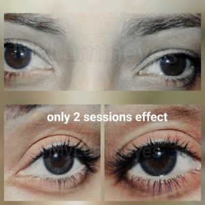 fastest-effective-laser-eye-color-change-machine-6g-5g-8g