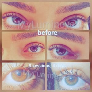 laser-eye-color-change-prices-mexico-barcelona-photosistanbul