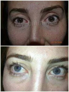 eye color change surgery laser