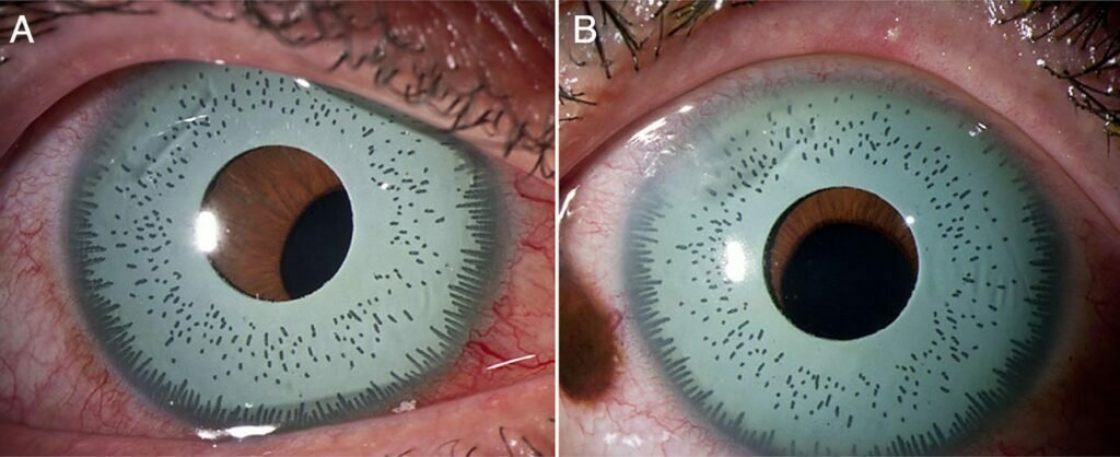 artificial iris implants and surgery
