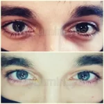 fotos de mudança de cor dos olhos a laser custa brasil méxico eua