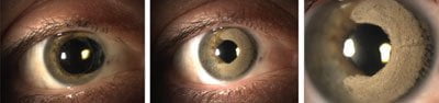 keratopigmentation laser eye color change surgery