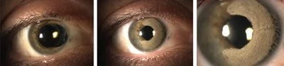 queratopigmentación láser cambio de color de ojos cirugía-tatuaje corneal