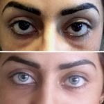 keratopigmentation eye color change surgery laser
