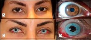 keratopigmentation-tattoo-eye-color-change