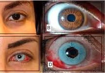 keratopigmentation-tattoo-eye-color-change