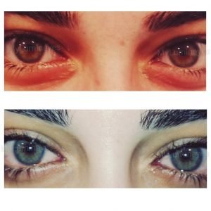 latisse eye color change reddit