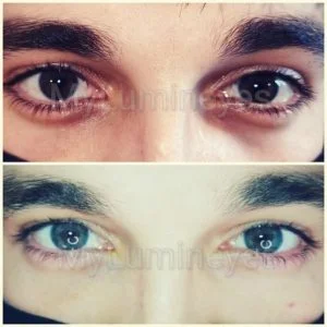 Custos-preços efetivos da cirurgia de mudança da cor dos olhos Turquia 2 antes depois das fotos mudança na cor dos olhos