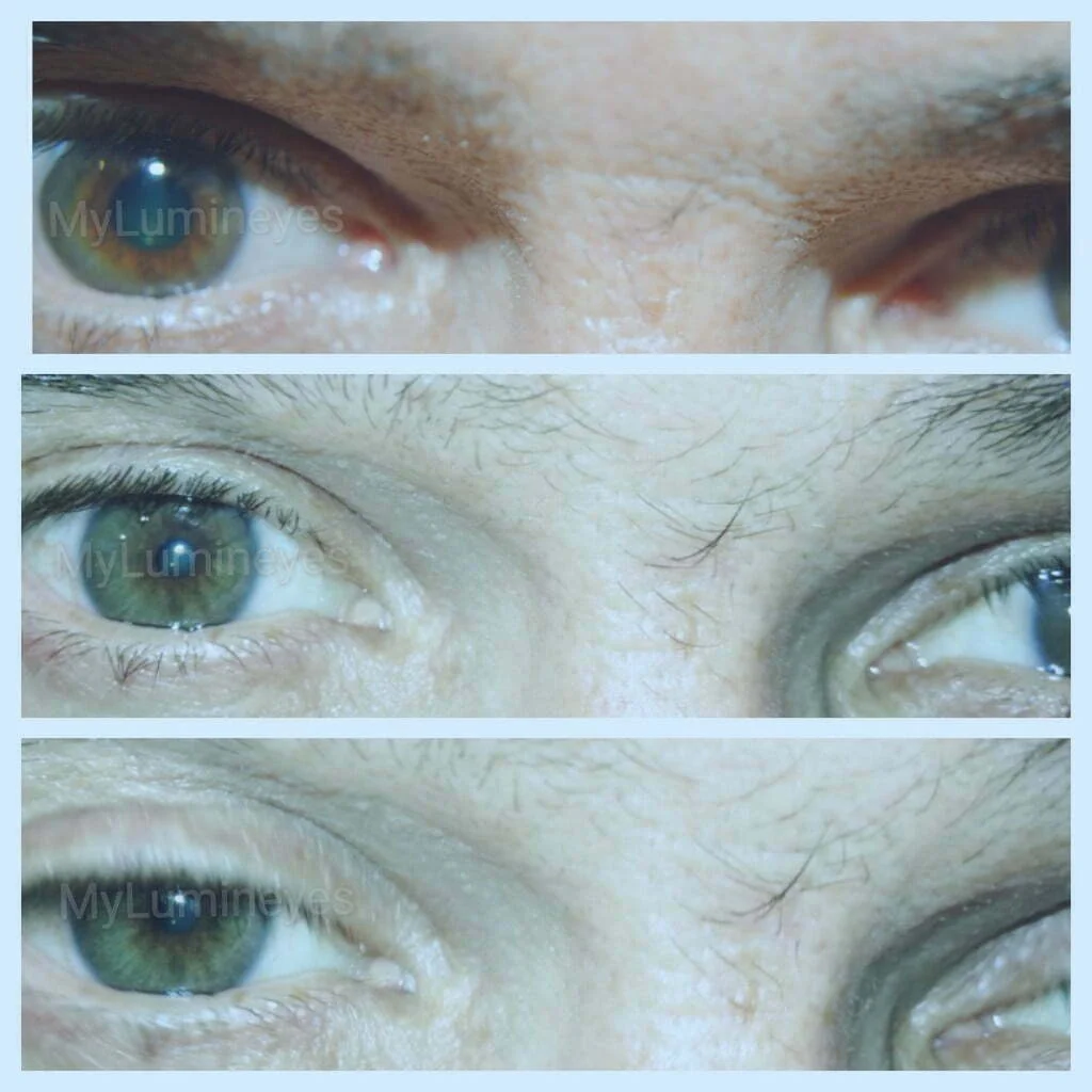 chirurgie de changement de couleur des yeux