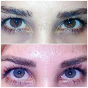 eye color surgery before after photos video