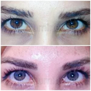 chirurgie de la couleur des yeux avant après photos vidéo