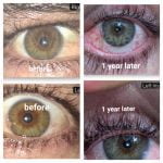 eye color change before and after photos mylumineyes