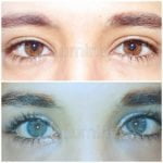 before and after photos eye color change