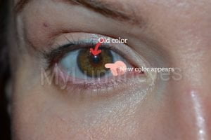 laser eye color change before after