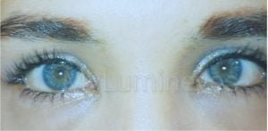 laser eye color change surgery Turkey Costs lumineyes after