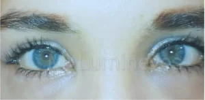 after laser eye color change