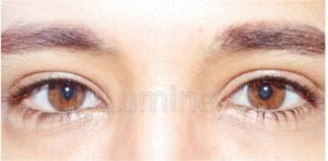 laser eye color change surgery Turkey Costs lumineyes before 1