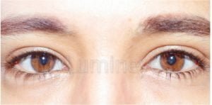 laser eye color change surgery Turkey Costs lumineyes crop