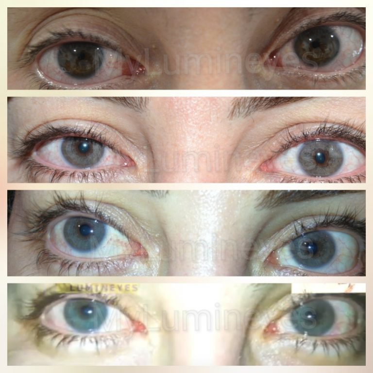 laser eye color change surgery Turkey