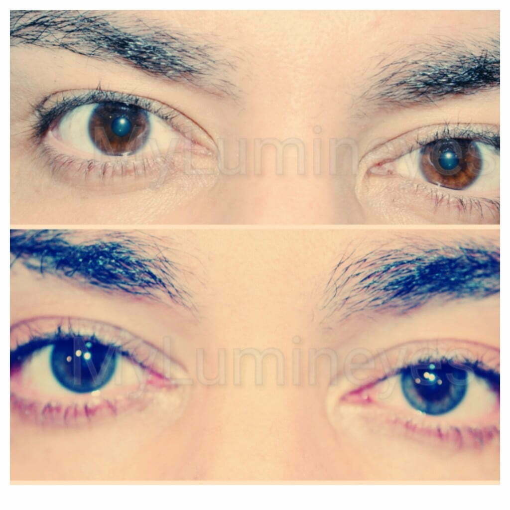 photos before and after surgery color eyes