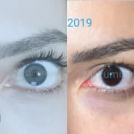 Reseñas de cambio de color de ojos con láser Turquía