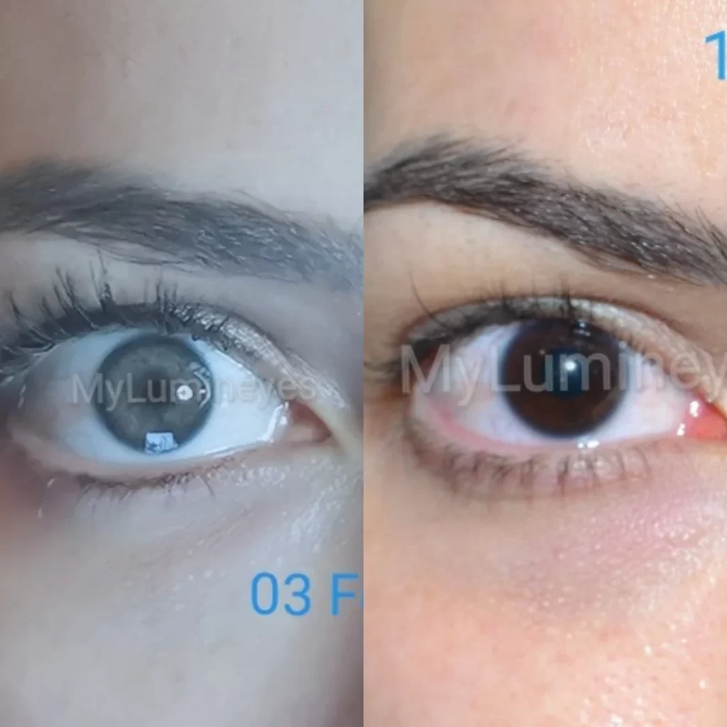 eye color change surgery costs Turkey