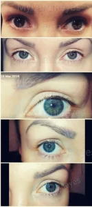 Mudança de cor dos olhos a laser antes e depois do preço