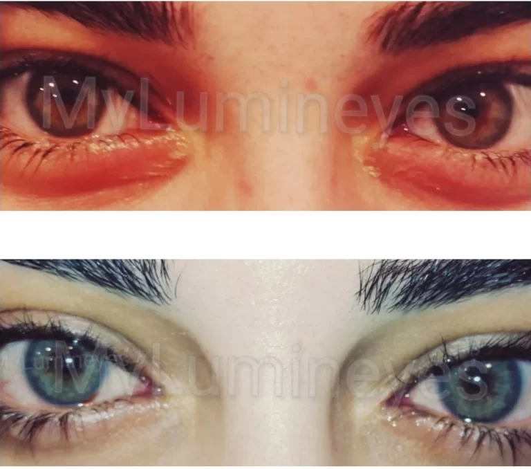 is laser eye color change safe