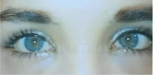 changing your iris color laser