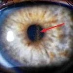 Eye color laser surgery Cost and Guide 9 heterochromia-pigmentary-glaucoma