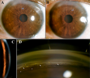 pigmentary-dispersion-syndrome-glaucoma