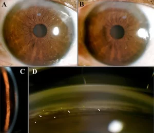 pigmentary-dispersion-syndrome