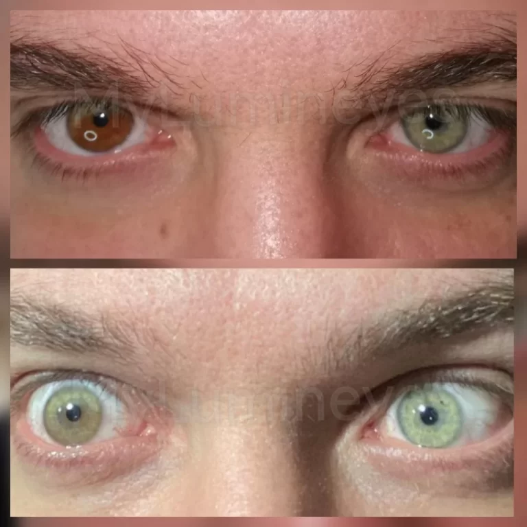 Before and after result of complete heterochromia treatment by Dr. Mustafa Mete, showing the permanent correction of asymmetrical eye colors using selective laser depigmentation.