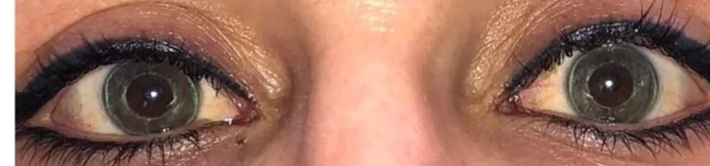 corneale-tatuaggio-cheratopigmentazione-laser-gioris-horn nik-as-new york-paris