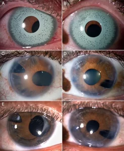 iris-implant-bright-ocular-surgery-risks