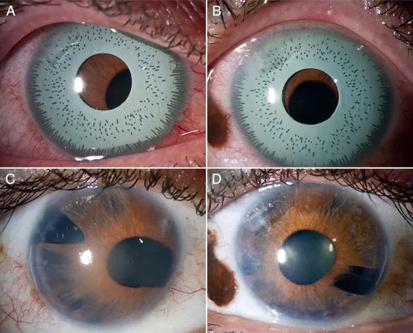 Iris implant surgery after explant