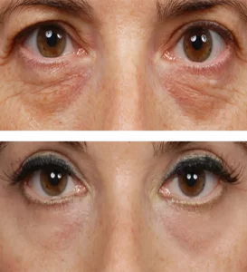 blefaroplasti 19 1000x1100