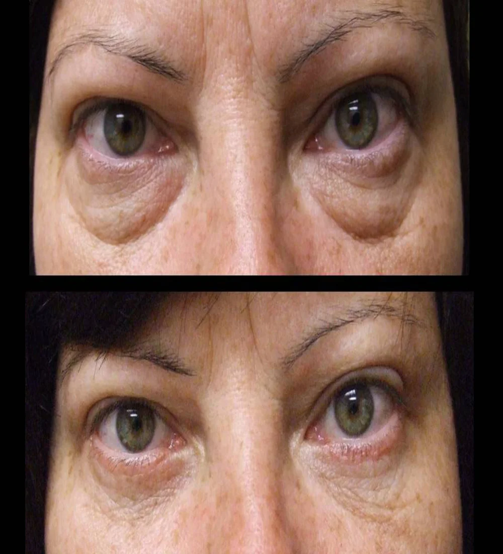 blepharoplasty-upper-lower-eyelid-surgery-Turkey