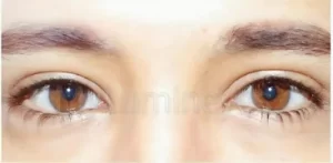 laser eye color change surgery Turkey permanent
