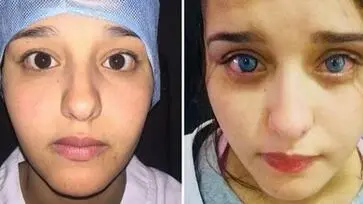 rischi di chirurgia del cambiamento del colore degli occhi
