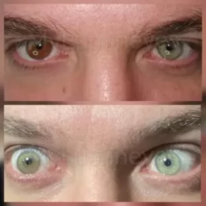Costo de cambio de color de ojos: sus ojos pueden cambiar de color