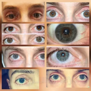 laser eye color change surgery